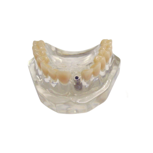 MAXILA ACRÍLICA COM DENTES E 1 IMPLANTE - cód. 4217A