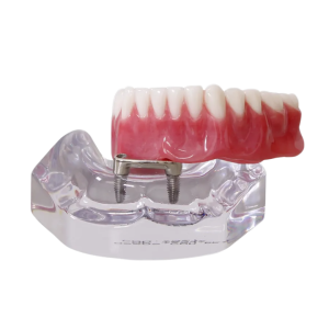 MANDÍBULA ACRÍLICA BARRA CLIP + PRÓTESE - cód. 9567