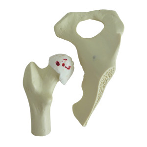 QUADRIL COM OSTEOARTRITE AVANÇADO - cód. 9598-4