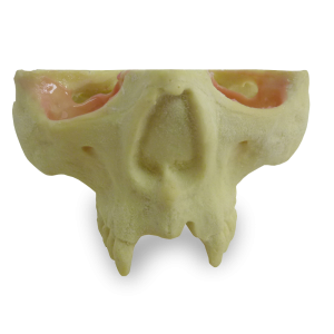 MAXILA COM AUSÊNCIA DOS DENTES - DENTES 11, 12, 21 E 22 - cód. 9971ST